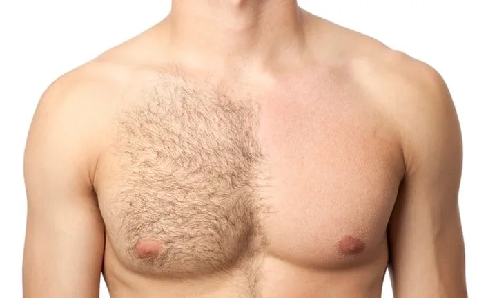 Körperhaartransplantation