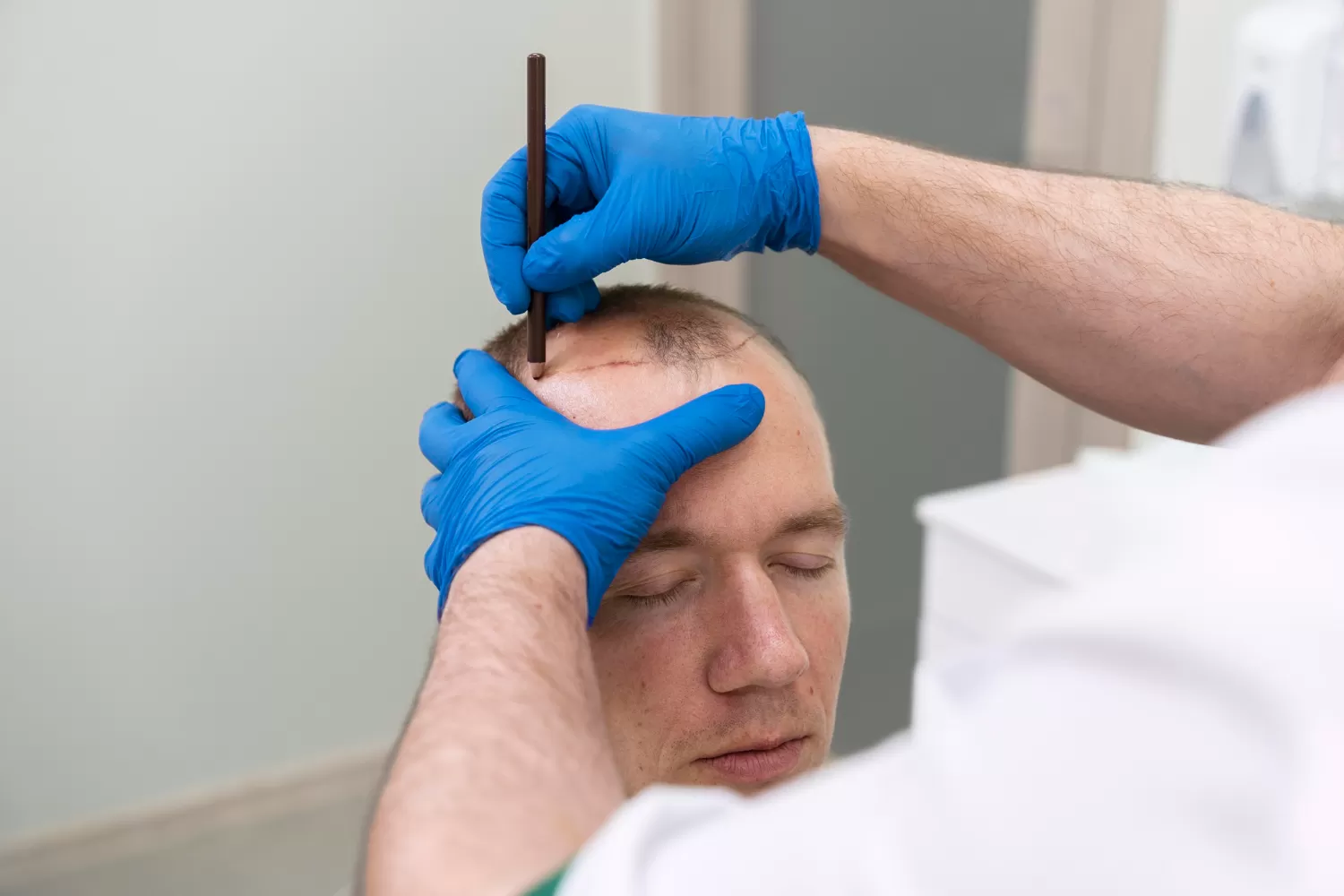 Manual FUE Hair Transplant