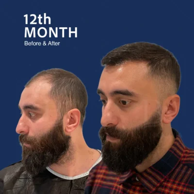 Before After 7
