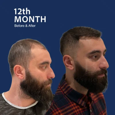 Before After 7