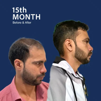 Before After 9