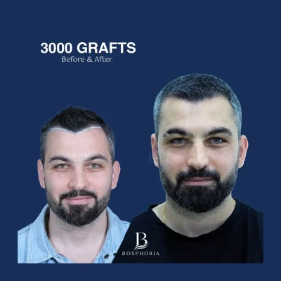Before After 5