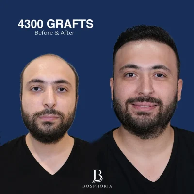 Before After 4
