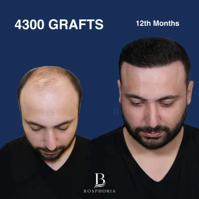 Before After 4