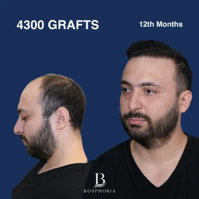 Before After 4