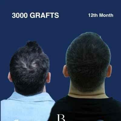Before After 5