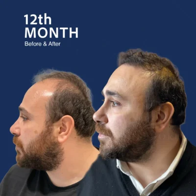 Before After 8