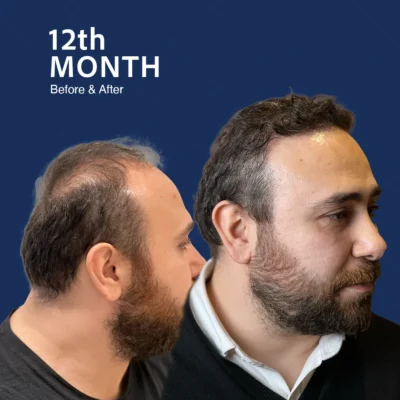 Before After 8