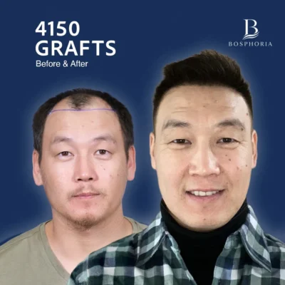 Before After 6