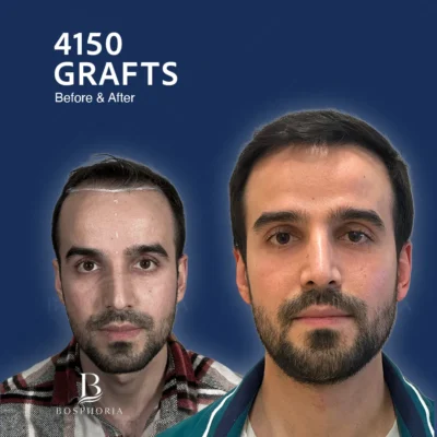 Before After 2