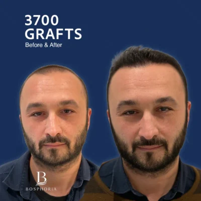 Before After 1