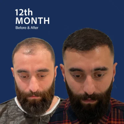 Before After 7