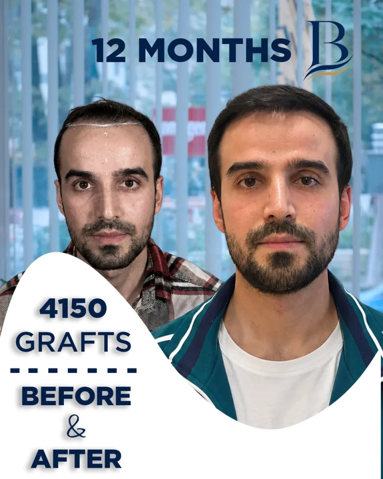 Kubilay Koşucu – 4150 Grafts Sapphire FUE Hair Transplant (18-Month Case Study)