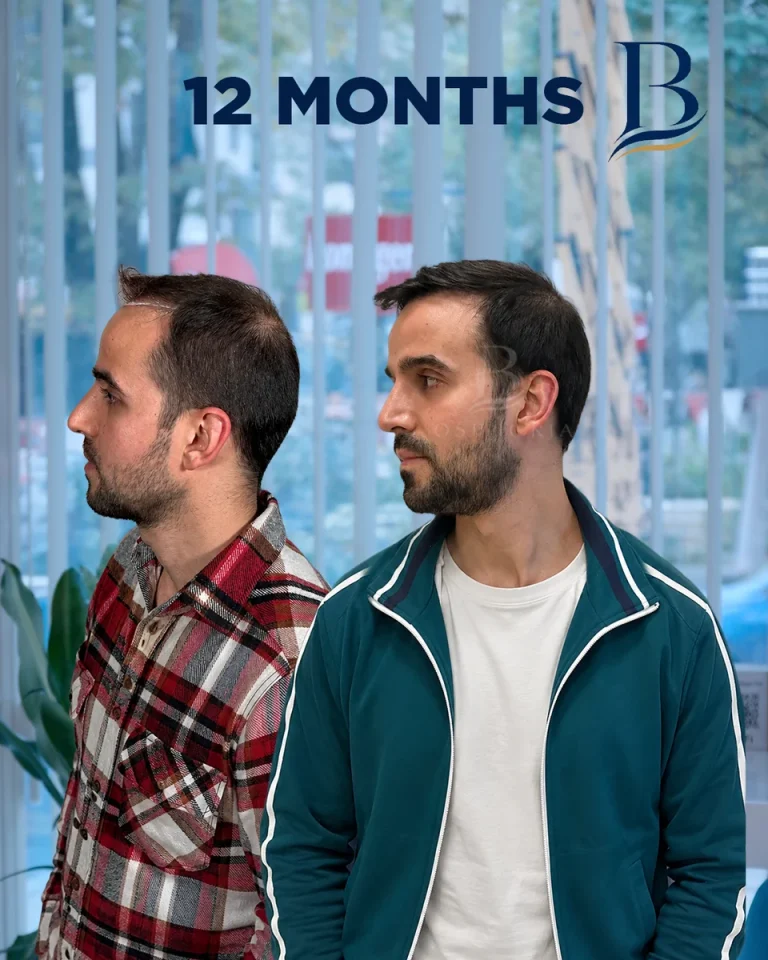 Kubilay Koşucu – 4150 Grafts Sapphire FUE Hair Transplant (18-Month Case Study)