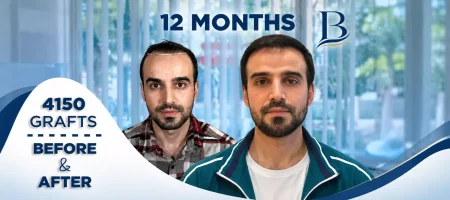 Kubilay Koşucu 4150 greft saç ekimi öncesi ve sonrası ön cephe karşılaştırma Bosphoria Hair İstanbul